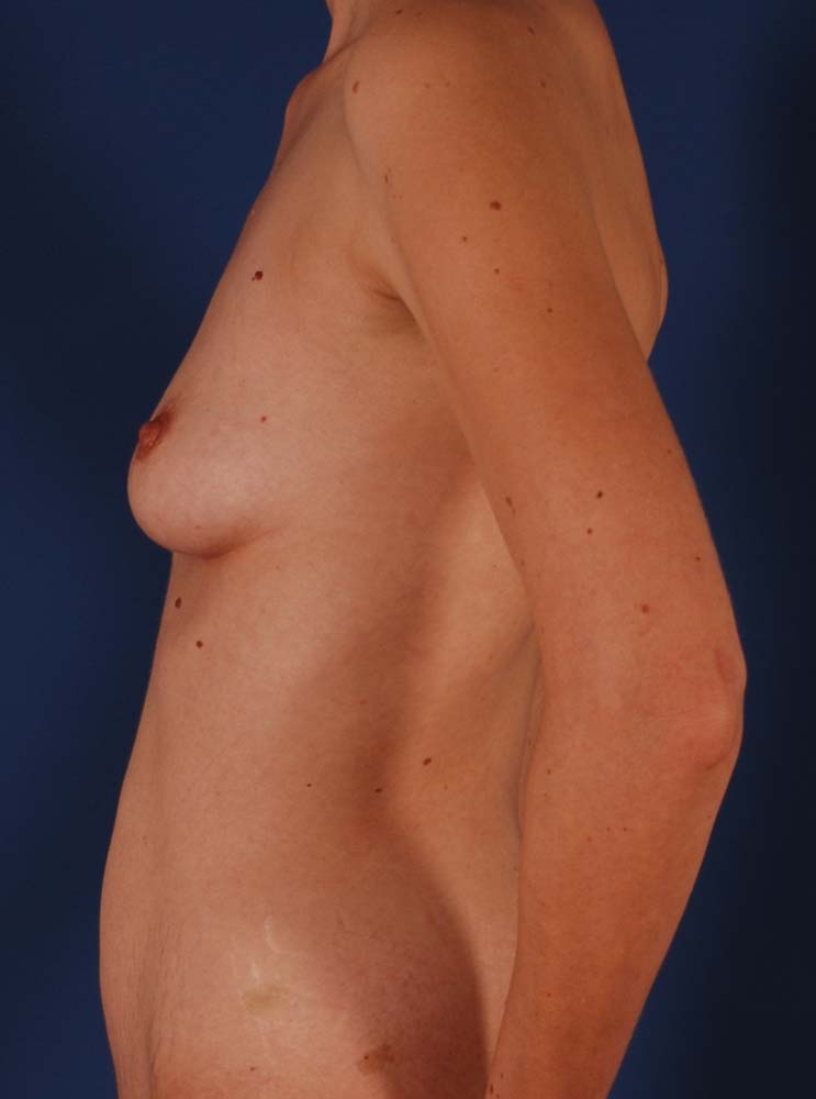 Photo de côté d'une patiente avant son augmentation mammaire naturelle par le Dr. Schlaudraff chez Concept Clinic, une clinique de chirurgie esthétique à Genève
