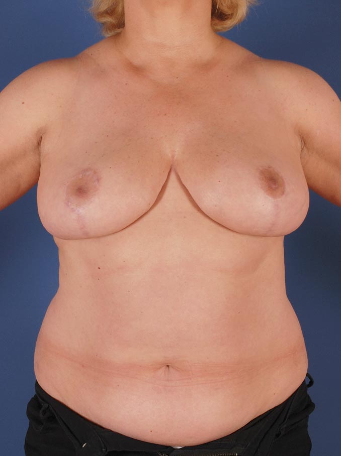 Photo de face d'une patiente après une réduction mammaire par le Dr. Schlaudraff chez Concept Clinic, une clinique de chirurgie esthétique à Genève