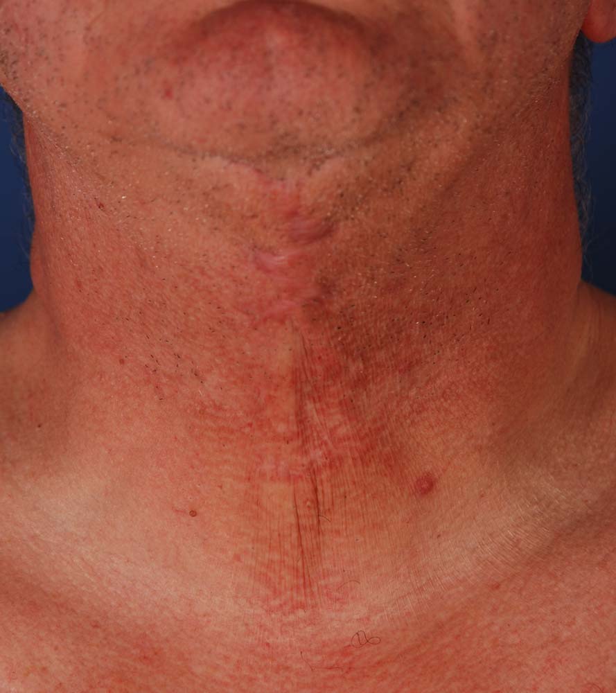 Photo de face d'une patiente après une correction de cicatrice par le Dr. Schlaudraff chez Concept Clinic, une clinique de chirurgie esthétique à Genève