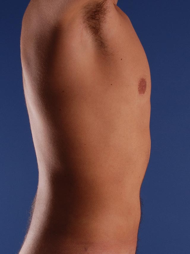 Photo de côté d'un patient après une liposuccion pour les hommes par le Dr. Schlaudraff chez Concept Clinic, une clinique de chirurgie esthétique à Genève