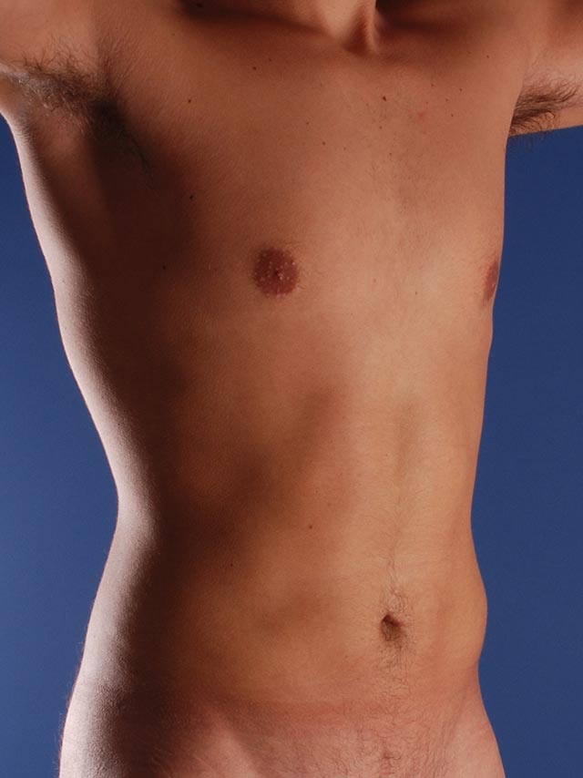 Photo oblique d'un patient aprèes une liposuccion pour les hommes par le Dr. Schlaudraff chez Concept Clinic, une clinique de chirurgie esthétique à Genève