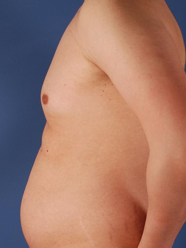 Photo de côté d'un patient avant une liposuccion pour les hommes par le Dr. Schlaudraff chez Concept Clinic, une clinique de chirurgie esthétique à Genève