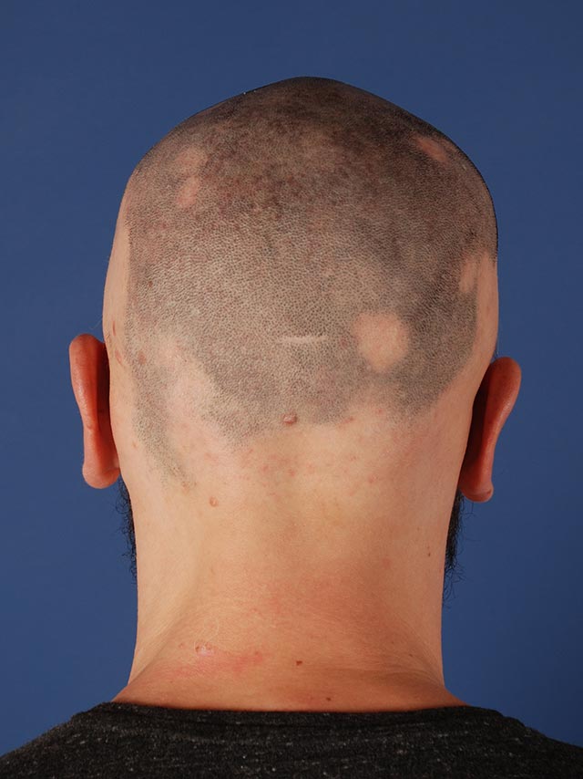 Vue arrière de la tête d'un patient après une otoplastie (chirurgie des oreilles décollées) par le Dr. Schlaudraff chez Concept Clinic, une clinique de chirurgie esthétique à Genève