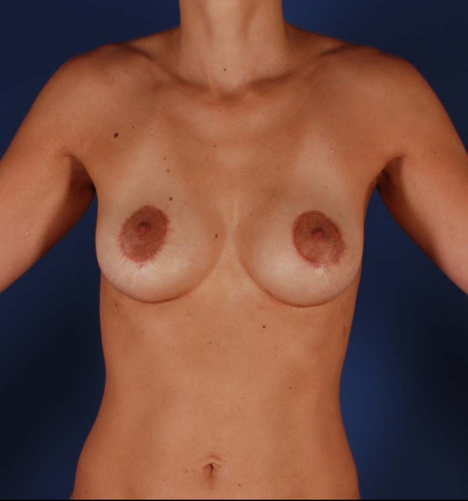 Photo de face d'une patiente après une reconstruction mammaire par le Dr. Schlaudraff chez Concept Clinic, une clinique de chirurgie esthétique à Genève