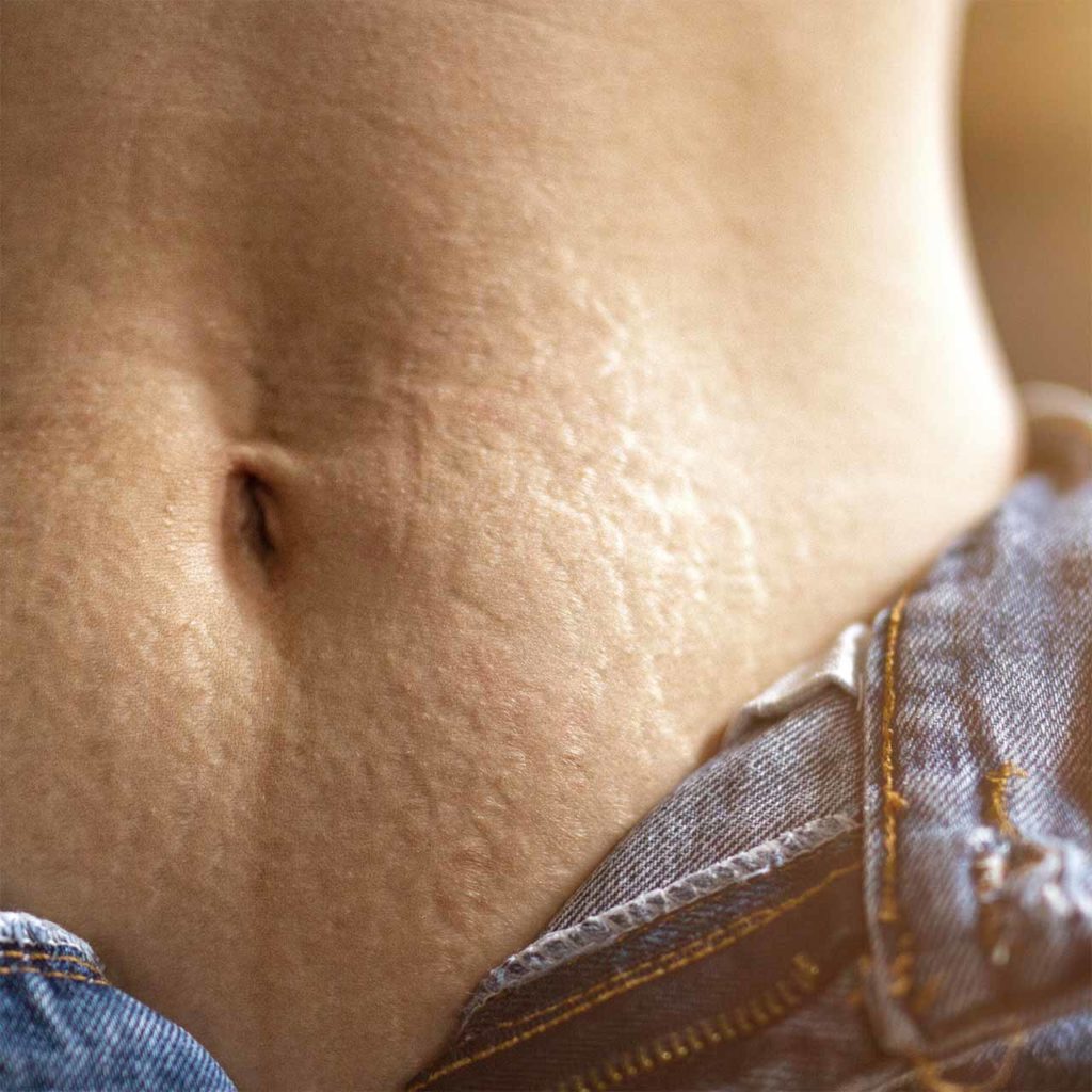 Belly of a woman with stretch marks illustrating an article on “how to avoid stretch marks” by Dr Schlaudraff and the Concept Clinic in Geneva.